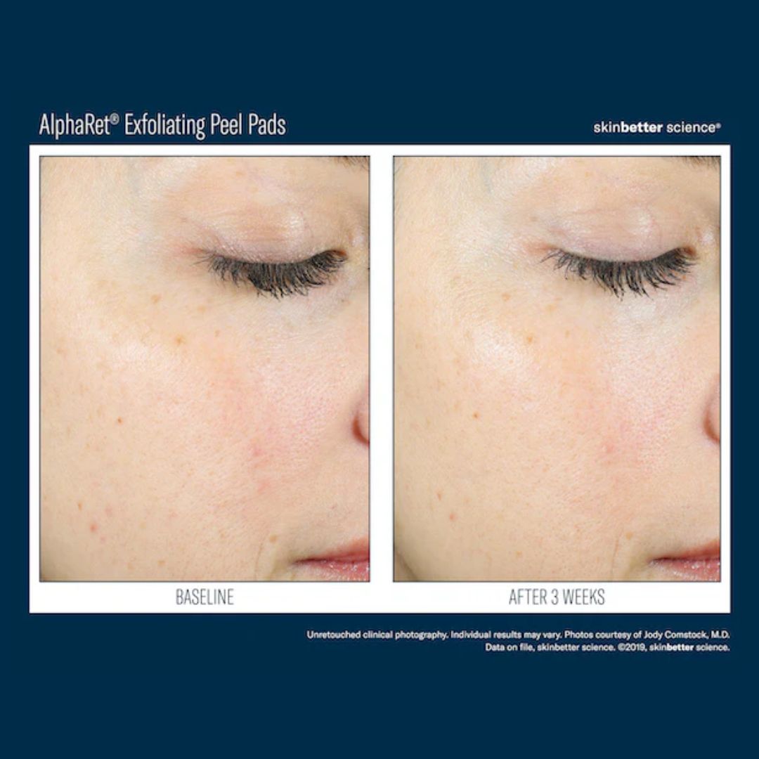 SKINBETTER SCIENCE® AlphaRet Peel Pads