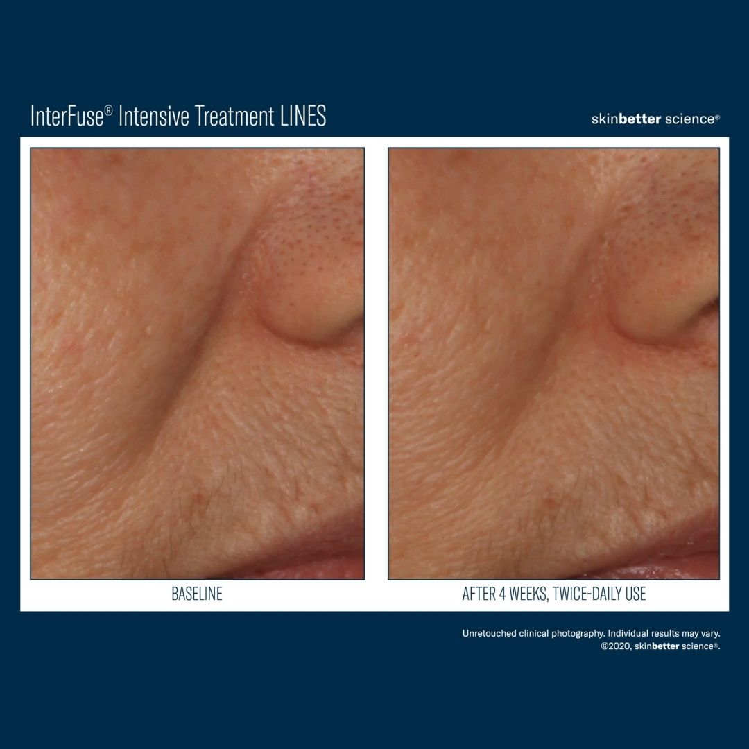 SKINBETTER SCIENCE® InterFuse Intensive Treatment LINES